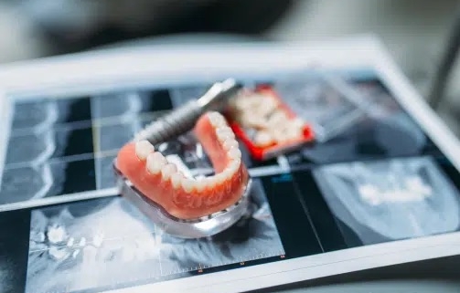 plan-tratamiento-protesis-fija